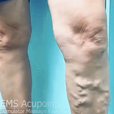 CUIDAMOS TU SALUD👩‍🔬 Estera de masaje para pies con estimulador de puntos de acupuntura EMS🫵
