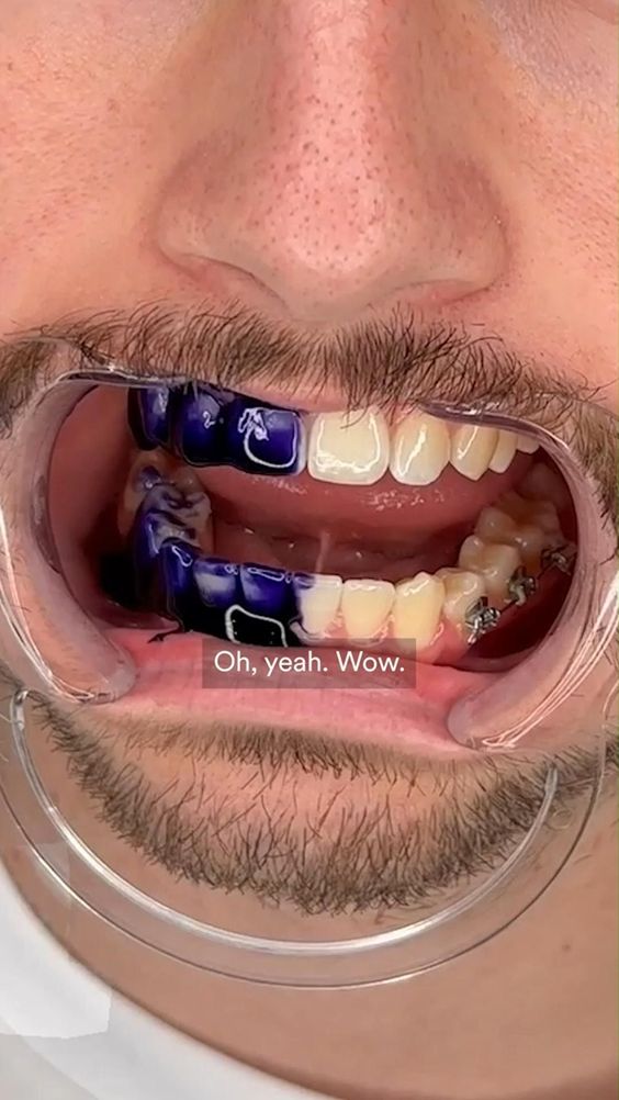 💜🌟CREMA DENTAL RESPLANDOR PURPLE SMILE V34 🌟👩‍🔬
